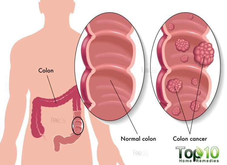 diag-colon-cancer