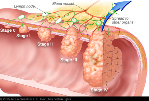 winslow_rm_illustration_of_colorectal_cancer_stages